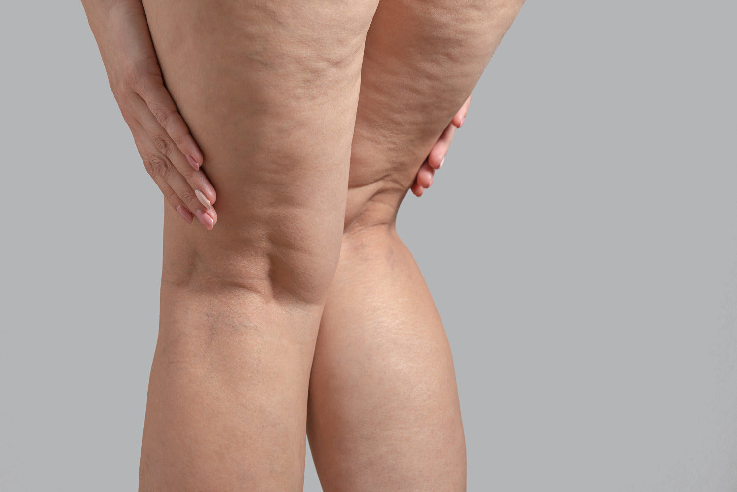 Cellulite & Bindegewebsschwäche – wie Kollagen helfen kann